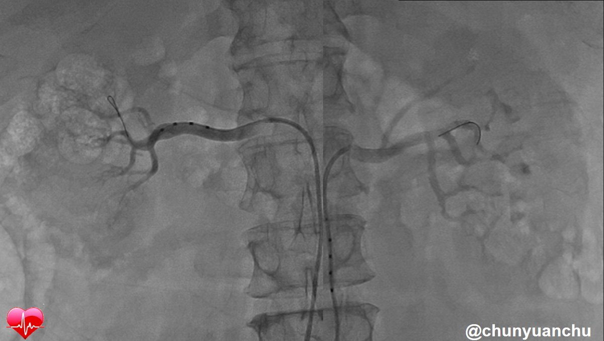 ChunYuanChu's tweet photo. Renal Denervation for uncontrolled HTN by our RDNi2 criteria in HTN guideline
@mmamas1973 @mirvatalasnag @dukwoo_park @summitmd_cvrf @EuroInterventio @PCRonline @aayshacader @MilevaNiya @MeralKayikcoglu
@reemhas88138365 @yongcheolkim2
@Hragy @AmitSinghMD @tonyhvo @KardiologieHH https://t.co/74B9I8MWb5