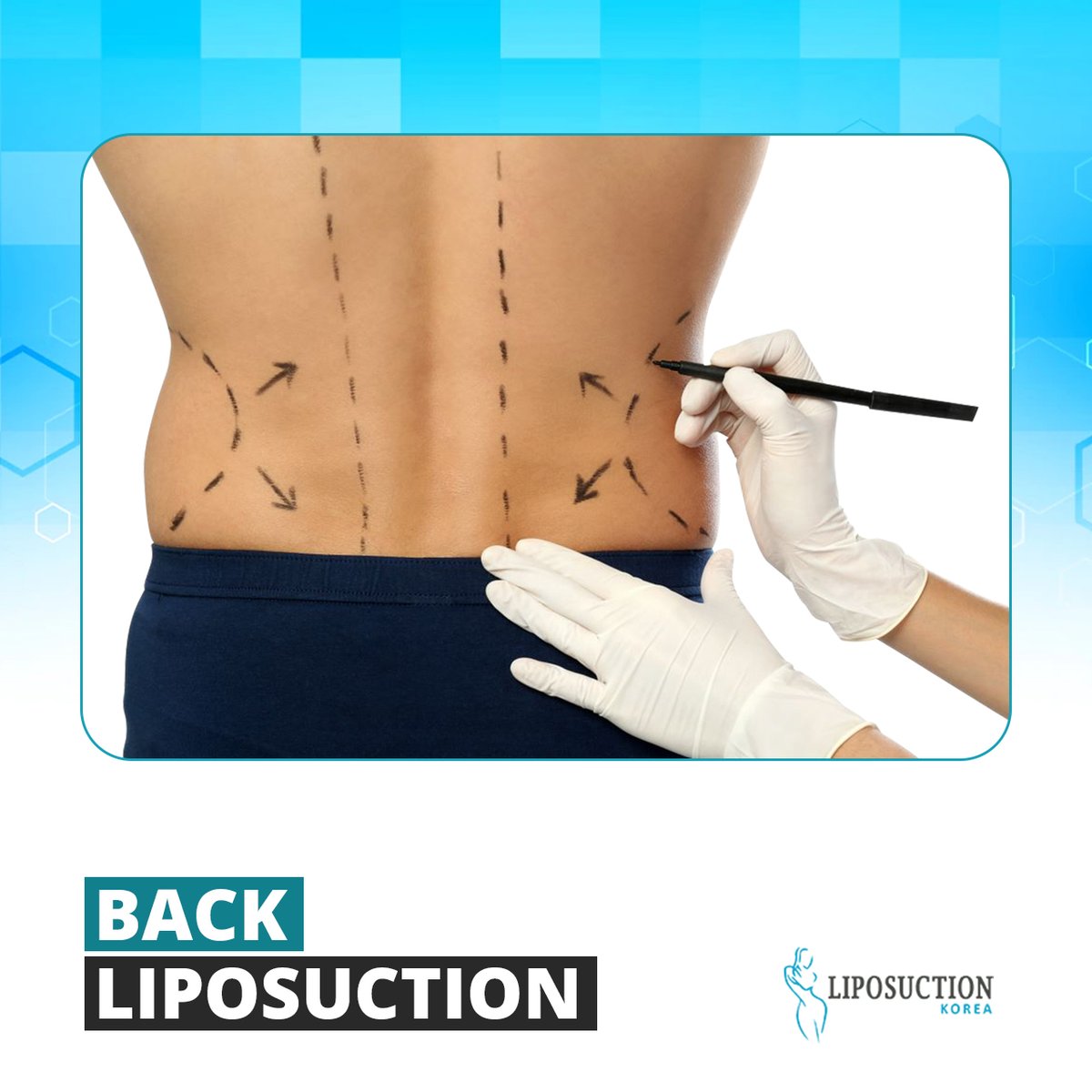 liposuctionkr's tweet photo. The back is an attractive portion of the body for both men and women.
Back Liposuction is a cosmetic procedure that removes fat from your back.
Consult👇
Email at📩: info@liposuctionkorea.com
https://t.co/T0mfTvR1IW
➡ Inbox Us: https://t.co/RaR0IM0BPf
#liposuction #backlipo https://t.co/hYdCsjz6pj