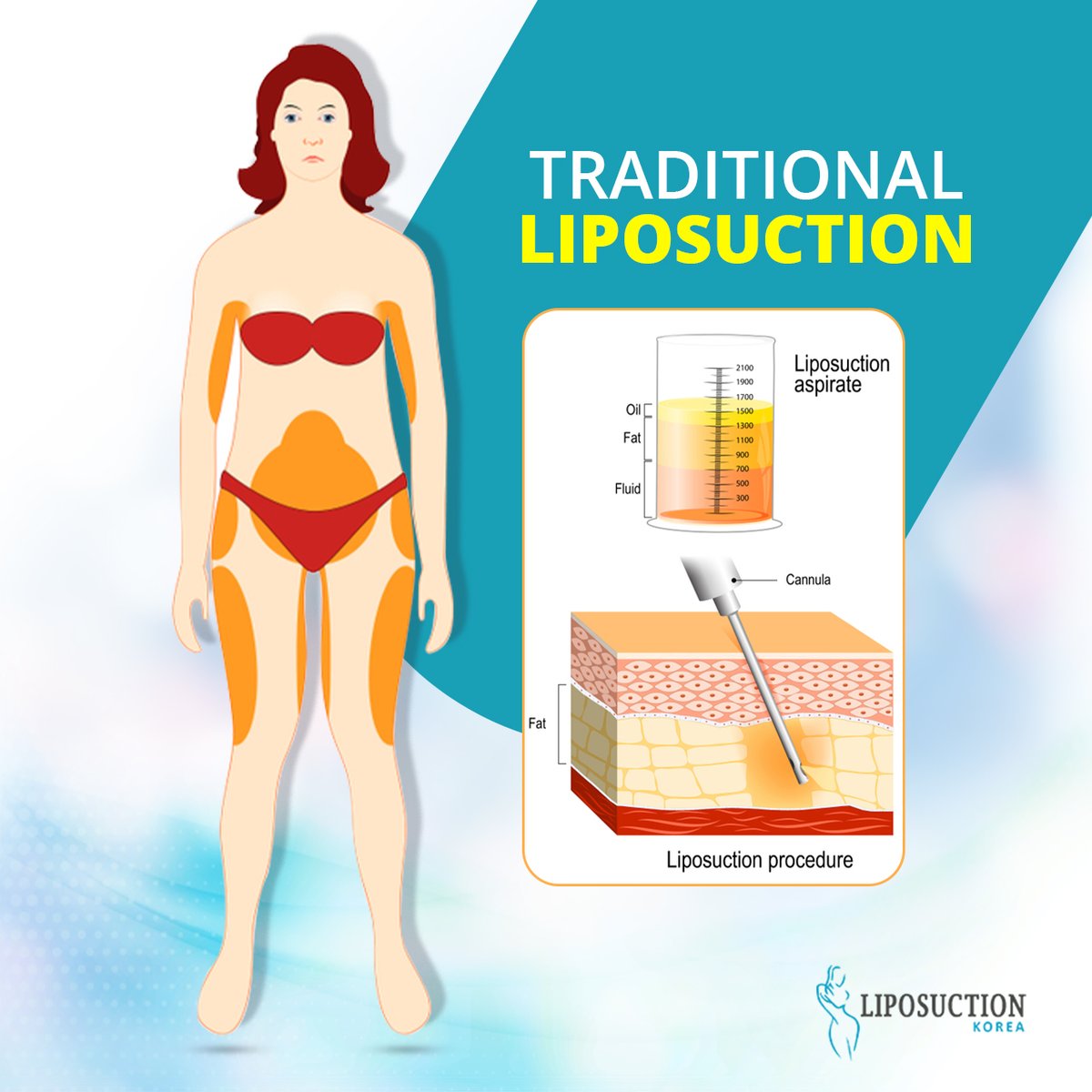 liposuctionkr's tweet photo. Traditional liposuction is essentially a fat vacuum for your https://t.co/forXxI1Vvi uses as a  suction method to rid your body of excess fat.
Consult👇
Email at📩: info@liposuctionkorea.com
https://t.co/T0mfTvR1IW
#Liposuction #TraditionalLipo #Traditional_liposuction #Fitness https://t.co/oBrf7d1oth