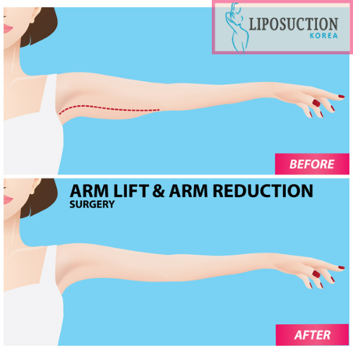 liposuctionkr's tweet photo. Your arm is the place of your body part that make you feeling comfort. So, if it becomes flabby, you will feel uncomfortable.
Consult👇
Email at📩: info@liposuctionkorea.com
https://t.co/T0mfTvR1IW
➡ Inbox Us: https://t.co/RaR0IM0BPf
#liposuctionkorea #armliposuction https://t.co/nv5ZwwOQsa
