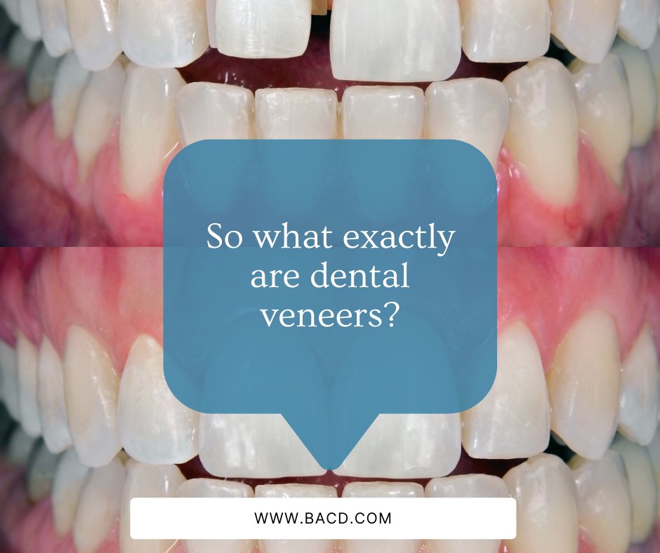 🦷 Veneers are wafer-thin laminates or shells of tooth-coloured material (which can be either porcelain, ceramic or composite bonding material). They are bonded to the front surface of teeth to improve their cosmetic appearance.
If you would like to know more, message us today!