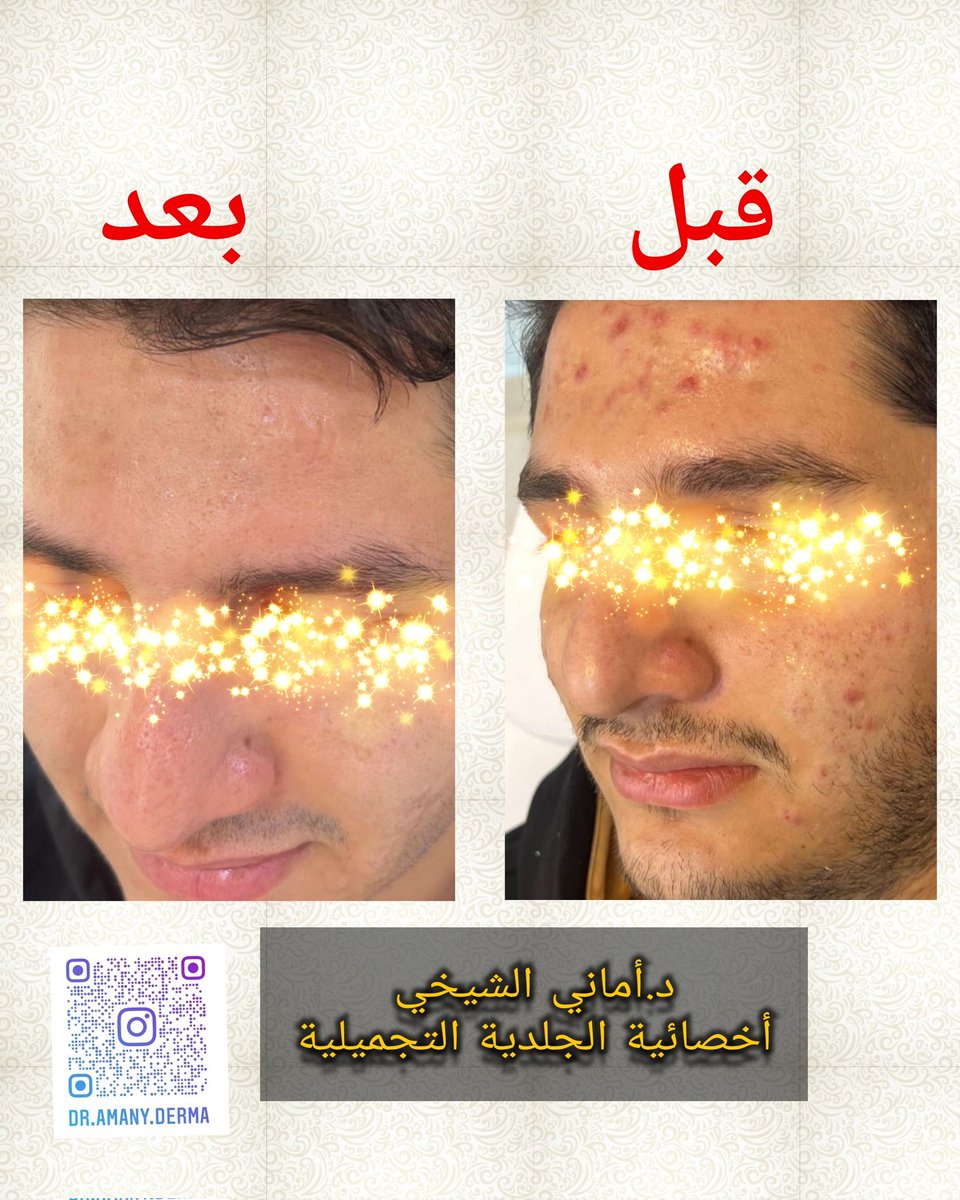 Dramanyderma's tweet photo. نتائج بروتكول علاج حب الشباب 
د.أماني الشيخي
#تجميل #بنغازي #حب_الشباب https://t.co/HqAOUVMNG3