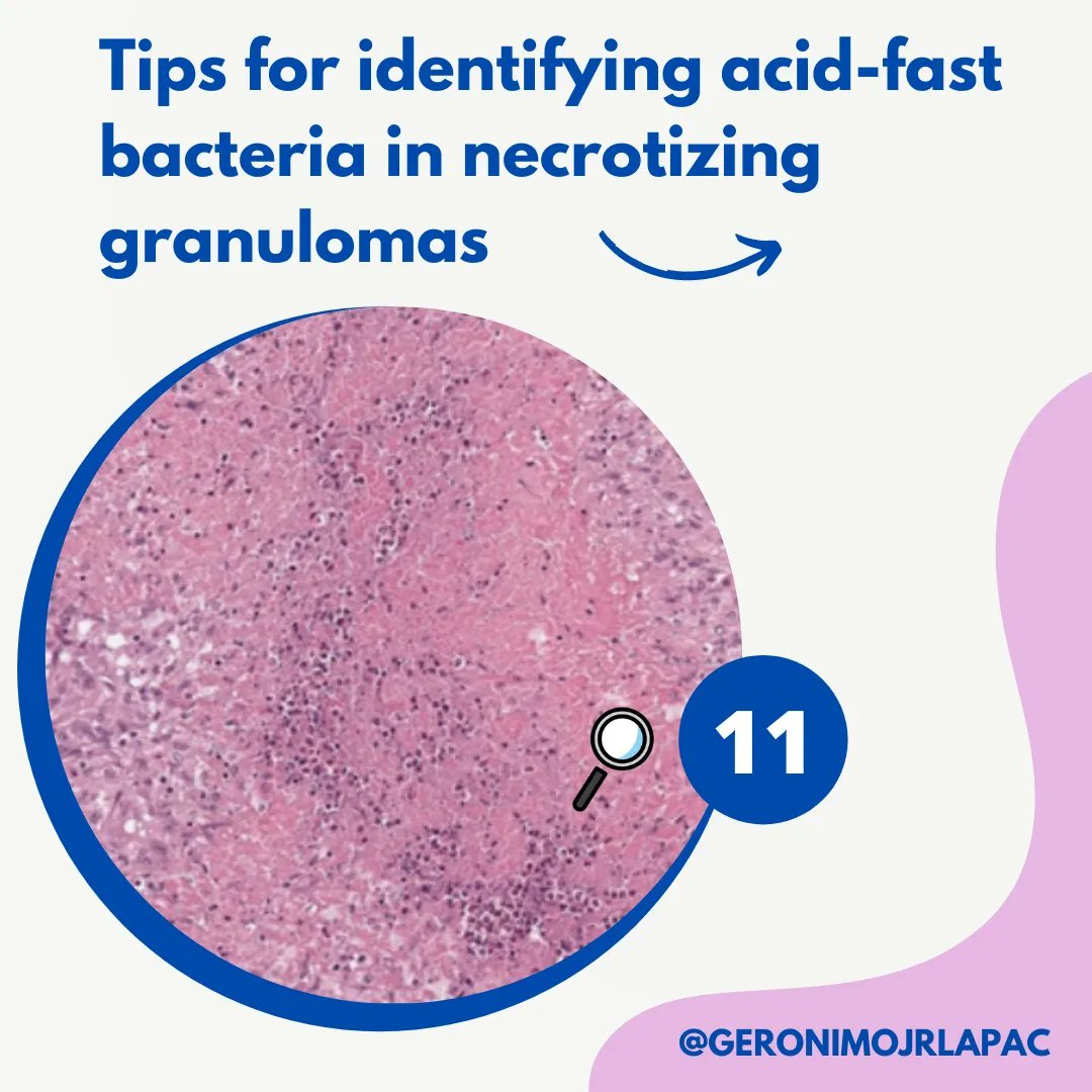 GeronimoJrLapac's tweet photo. #pathology #surgpath
See comment.
More one wonderful and useful article from @smlungpathguy
Ref: https://t.co/TjvgXLdZ0C https://t.co/gKIrsuV2tm