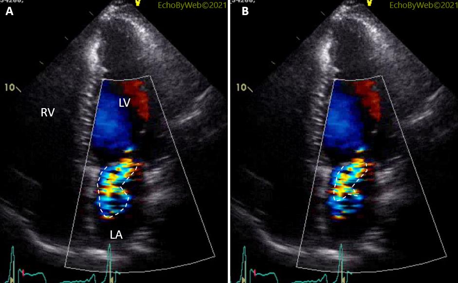 echobyweb's tweet image. How to Quantify Early Systolic Mitral Regurgitation - The importance of timing
In: echobyweb.com/?p=2593
#CardioTwitter #cvImaging #cvEcho #echofirst #cardiology #methodology #mitralregurgitation