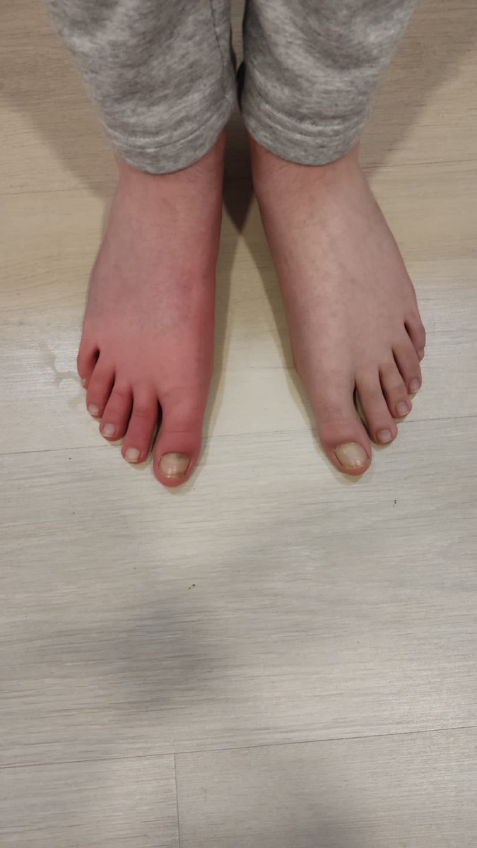 Los pacientes con SDRC son ese tipo de personas que te bajan a la tierra y ponen de manifiesto los “límites terapéuticos “ de cada profesional sanitario. “¿Cuando me recuperaré?”, “Por que me ha ocurrido?”, “¿Que tengo que hacer para curarme”?