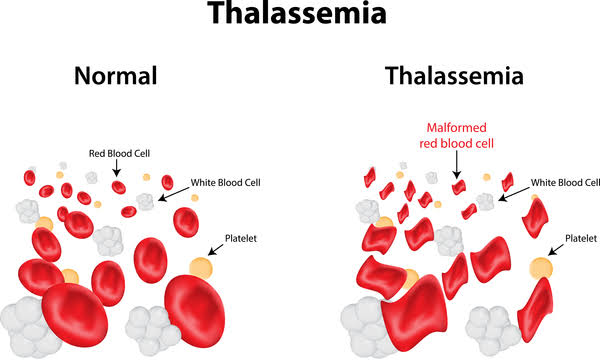 NoorUlHudaSha12's tweet photo. Seethe difference between a normal Red Blood Cells and those who are Malformed. 
#JZTPakistan #WorldThalassemiaDay https://t.co/NeLQE2wVW8