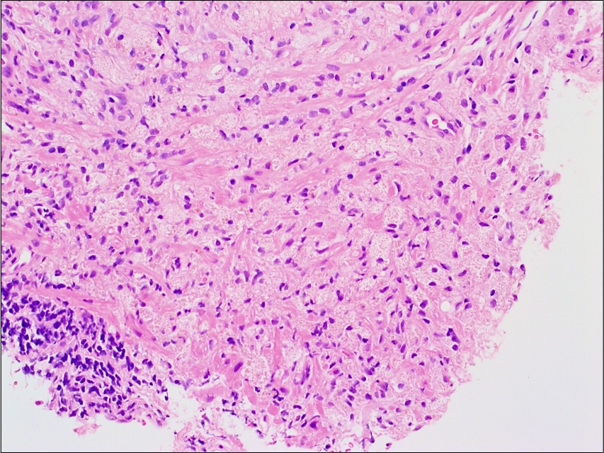s_prendeville's tweet photo. Prostate biopsy xanthoma

➡️May mimic prostatic adenocarcinoma, especially foamy gland adenocarcinoma #pathpitfall
➡️ cd68+; epithelial markers -

#pathresidents #gupath https://t.co/p3O0dlgaSn