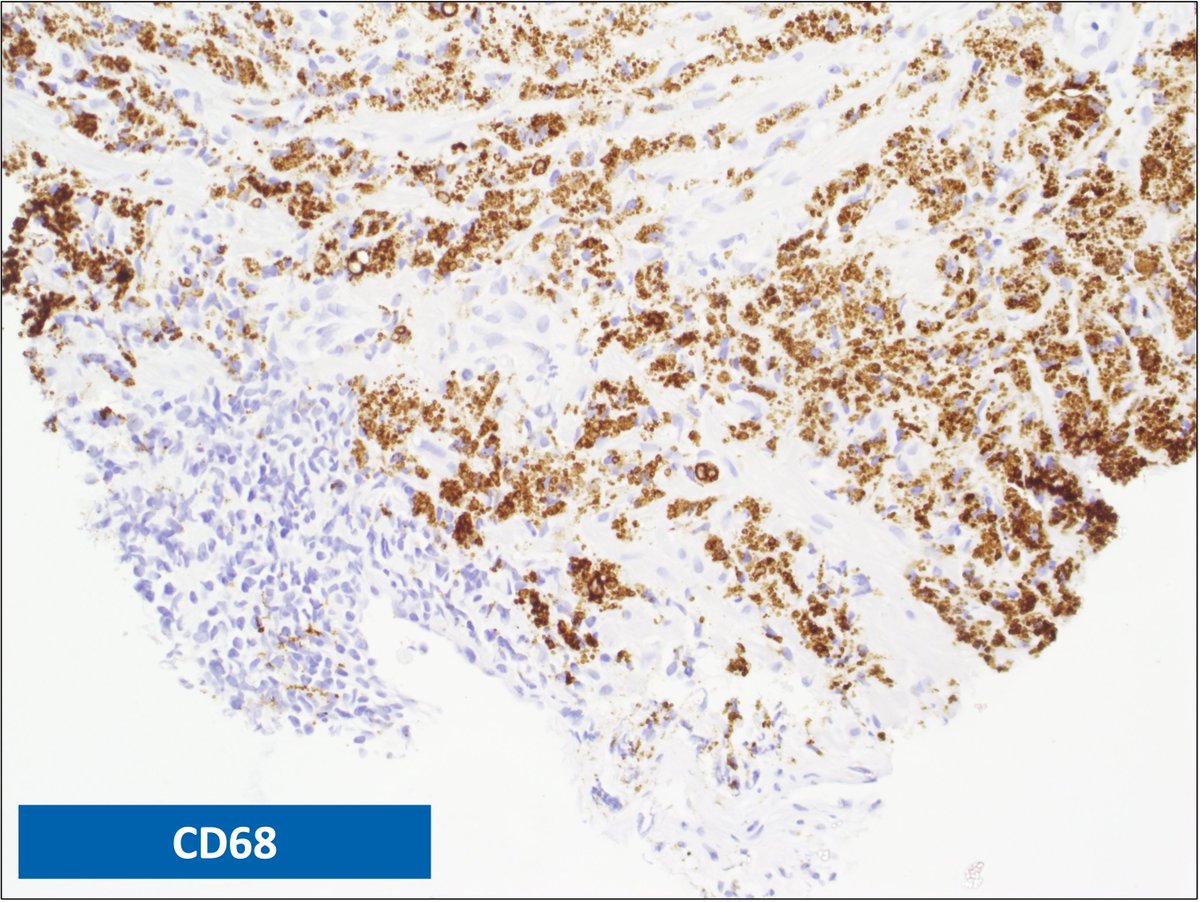 s_prendeville's tweet photo. Prostate biopsy xanthoma

➡️May mimic prostatic adenocarcinoma, especially foamy gland adenocarcinoma #pathpitfall
➡️ cd68+; epithelial markers -

#pathresidents #gupath https://t.co/p3O0dlgaSn