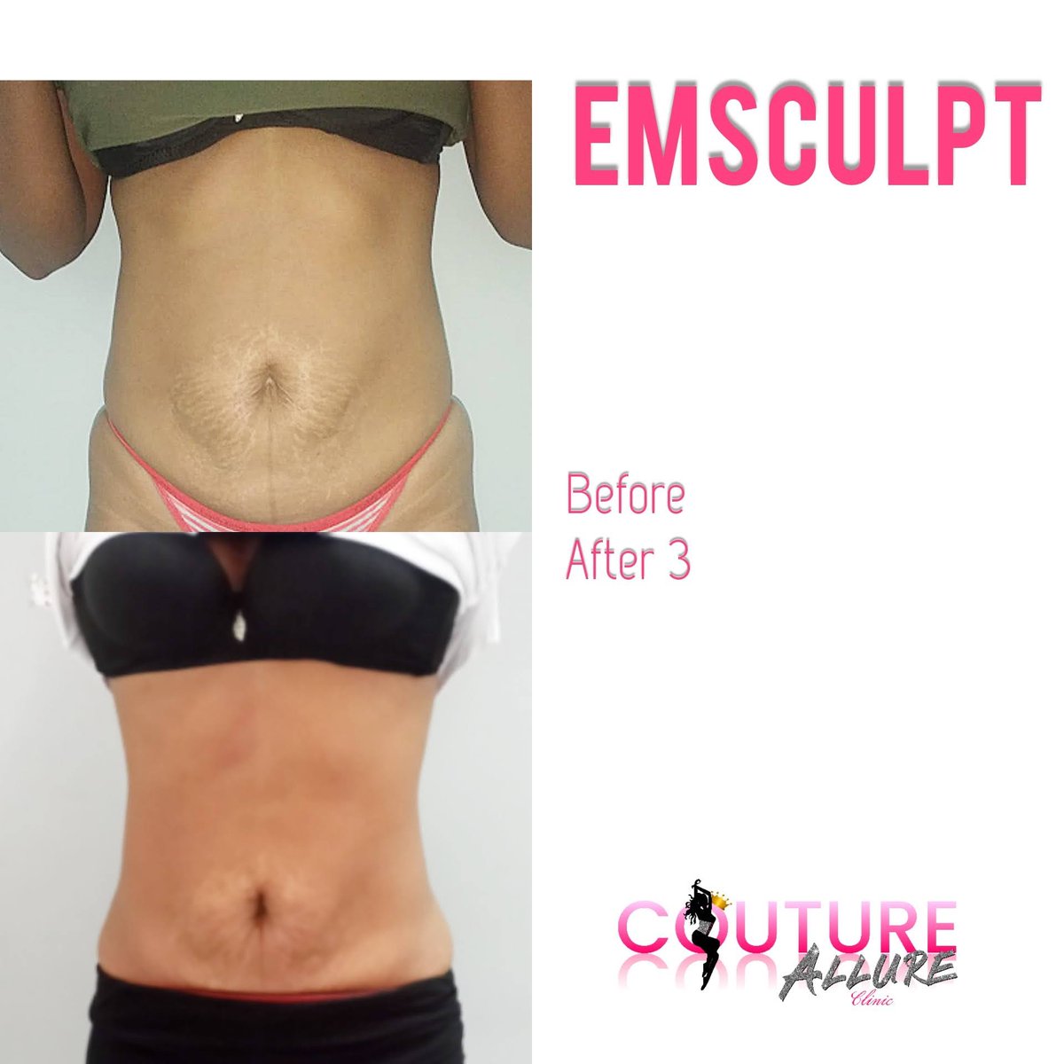 Emsculpt Ladies &amp; Gents?  Sculpt Your Abs and or reduce fat at the same time.  Contact us to find out more!
#EmsculptJamaica
#CoutureAllureClinic