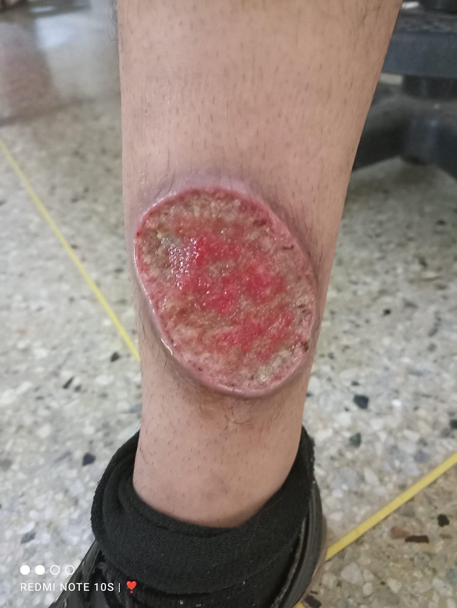 mundomicro2's tweet photo. @mICROBIOsh Paciente de 14 años. Procedente de zona rural. Leishmaniasis https://t.co/Ly3QLvCHVk