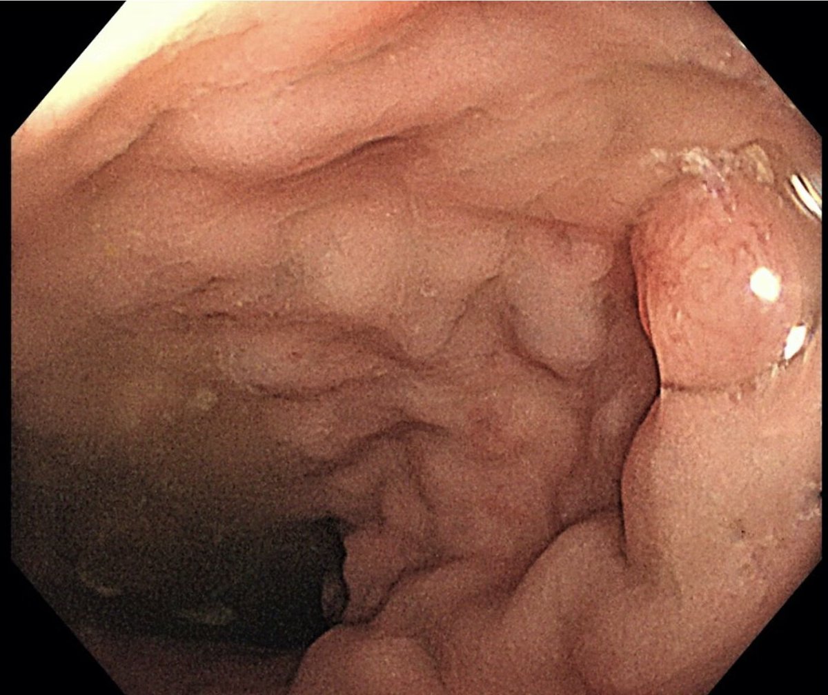 EndoCollab™ | GI Endoscopy Community tweet media