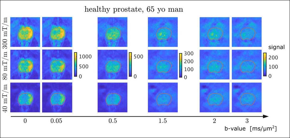 Have you ever wondered how prostate MRI images from 300mT/m Connectom Siemens scanner would look like? Join us Tues. May 10th, 9.15am at “Advances in Prostate Imaging” (#0223).  Work with <a href="/MarcoPalombo3/">MarcoPalombo</a> <a href="/LauraPanagio/">Eleftheria (Laura) Panagiotaki</a> @Dee_Kay_Jay <a href="/ChantalTax/">Chantal Tax</a> et al. 
#siemens #ISMRM2022 #prostate