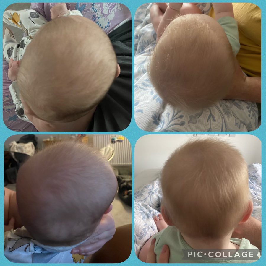 متى يقلق الأهل من حجم رأس الطفل؟