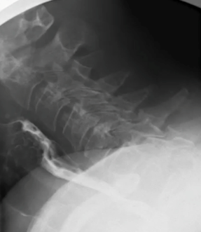 MapsciP's tweet photo. https://t.co/zzQ9GlS7Ey 

Post-intubation Tracheoesophageal Fistula In Severe Sars-cov-2 Covid-19 Patient: An Unexpected Finding During Swallowing Test

https://t.co/VD8PQx4tqV https://t.co/9L9usOJrfX