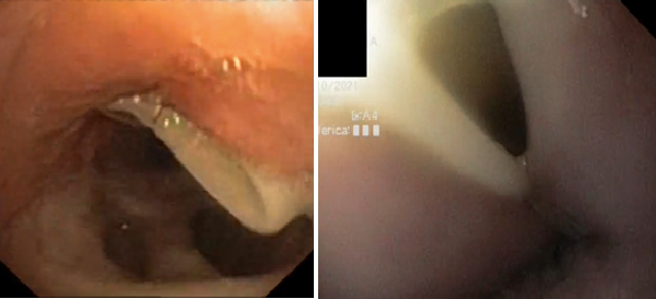 MapsciP's tweet photo. https://t.co/zzQ9GlS7Ey 

Post-intubation Tracheoesophageal Fistula In Severe Sars-cov-2 Covid-19 Patient: An Unexpected Finding During Swallowing Test

https://t.co/VD8PQx4tqV https://t.co/9L9usOJrfX