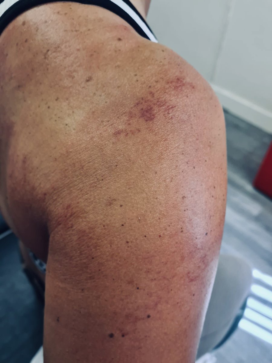 cj_pompey's tweet photo. After competing, once I got Stan home and sorted, I headed to the Chiropractor for some much needed help! Yep I really am good at hurting myself! There were tears! Got a tear in my muscle in my upper arm plus a lot of other damaged places! Back again next week! #ouchies #needtlc https://t.co/jf8OhvKmzH