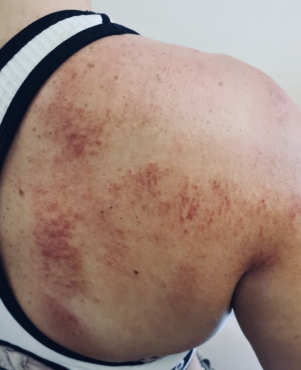 cj_pompey's tweet photo. After competing, once I got Stan home and sorted, I headed to the Chiropractor for some much needed help! Yep I really am good at hurting myself! There were tears! Got a tear in my muscle in my upper arm plus a lot of other damaged places! Back again next week! #ouchies #needtlc https://t.co/jf8OhvKmzH