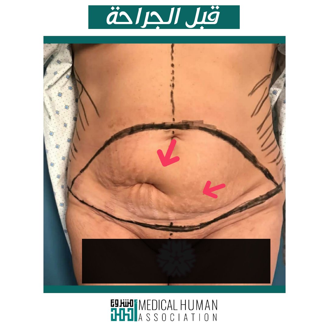 Meddose1's tweet photo. بعد تعدد الولادات القيصرية قد تعاني الأم من ندبات كثيرة في البطن كما حدث مع مريضتنا العزيزة

أُضيف لذلك ~> #اندحاق لجرح (انخماص) بعد عملية زايدة ! 

لم تملك السيدة مبلغاً كافياً لمعالجة ذلك
كان لنا الشرف دائما بأن يثق بنا مرضانا 

#مشروع_أحمد ~ #الجراحة_التجميلية_الترميمية https://t.co/oO7fnUvQ5i