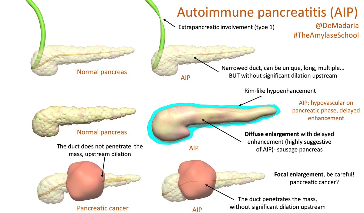 DeMadaria's tweet photo. Imaging features of autoimmune pancreatitis 

#UEGambassador #TheAmylaseSchool #GItwitter #PancreasTwitter #HiloAEG @my_ueg @aegastro #3Dmodeling
More details during my talk about autoimmune pancreatitis in the upcoming @EurPancClub meeting, see next tweet https://t.co/2RTaTg13UH