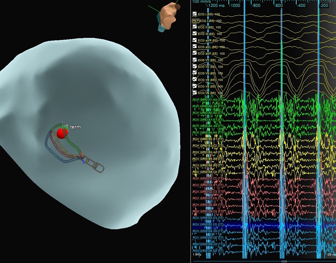 Amir Schricker (@axisdeviation) on Twitter photo Great VT ablation in “ischemic cardiomyopathy”. Endo LV/RV normal. Epi ILAM with #HDgrid saved the day. Pics: epi scar, epi ILAM, crazy signals at term site. <a href="/EPWoodsShop/">Christopher Woods</a> <a href="/rabinkova/">Anna</a> <a href="/DrRoderickTung/">Roderick Tung</a> Great VT ablation in “ischemic cardiomyopathy”. Endo LV/RV normal. Epi ILAM with #HDgrid saved the day. Pics: epi scar, epi ILAM, crazy signals at term site. <a href="/EPWoodsShop/">Christopher Woods</a> <a href="/rabinkova/">Anna</a> <a href="/DrRoderickTung/">Roderick Tung</a>