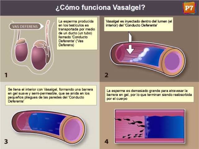 endo_roberto123's tweet photo. @RoTuits No sé qué tan sano es que inyecten en cada conducto del testiculo una sustancia que genera esa barrera. 👀 https://t.co/Vu2DHfyyDK