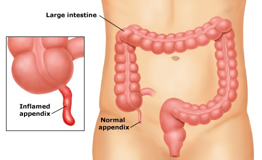 Janesthsurgres's tweet photo. An appendectomy, also termed appendicectomy, is a surgical operation in which the vermiform appendix is removed. Appendectomy is normally performed as an urgent or emergency procedure to treat complicated acute appendicitis.
#surgery #appendectomy #laparoscopically #appendix https://t.co/ivyiTOjoAe