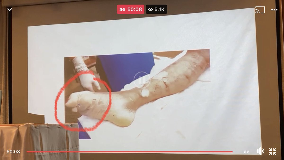 เราตามข่าวตามไลฟ์หาร่างคุณแตงโมตั้งแต่วันแรกจนวันพบร่าง รูปแรกคือวันแรกเลยที่พบขาสวยและร่องรอยแทบไม่มีเลยด้วยซ้ำอะ 
#แตงโมต้องได้รับความยุติธรรม