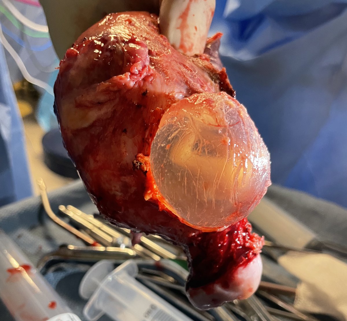 jmourad1's tweet image. Consequences of an untreated uterine niche/isrhmocoele. Imperative to close c-sections in a reproducible, safe manner to avoid these. Patient counseling is key. placenta increta at 12 weeks @uacomp_obgyn