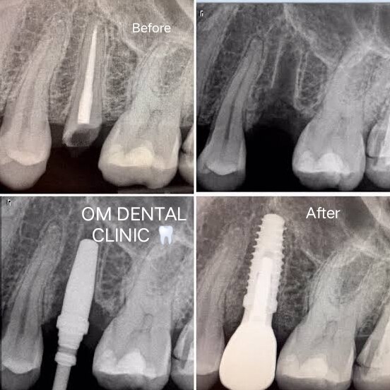 OMDENTALCLINICS's tweet photo. No tooth?no problem!At smilesby morel we can place an implant and re ..For more info visit...https://t.co/tVacAPpWe7 https://t.co/RlfrvDmUi5