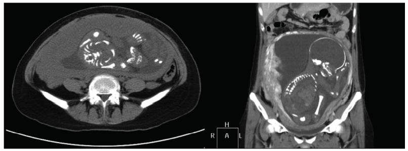 CEOGjournal's tweet photo. Can pregnancy following muscle-sparing transverse abdominis myocutaneous (MS-TRAM) flaps be safe on abdominal wall?
🔎https://t.co/1RI1tKKH7b
#TRAM #pregnancy #Breast #cancer #MSTRAM https://t.co/WtqPSmuQ6o