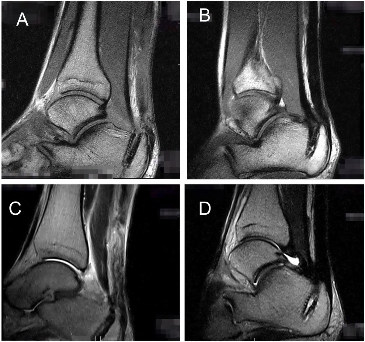 AOFAS_Journals's tweet photo. Authors describe use of an endoscopic FHL tendon transfer for acute Achilles injuries in 27 professional soccer players, mean follow up of 26mos. 82% returned to pre-injury levels &amp; resumed their professional career at the same soccer club. https://t.co/bWwXWb21pe @DrNasefClinic https://t.co/9VXjPN6e8C