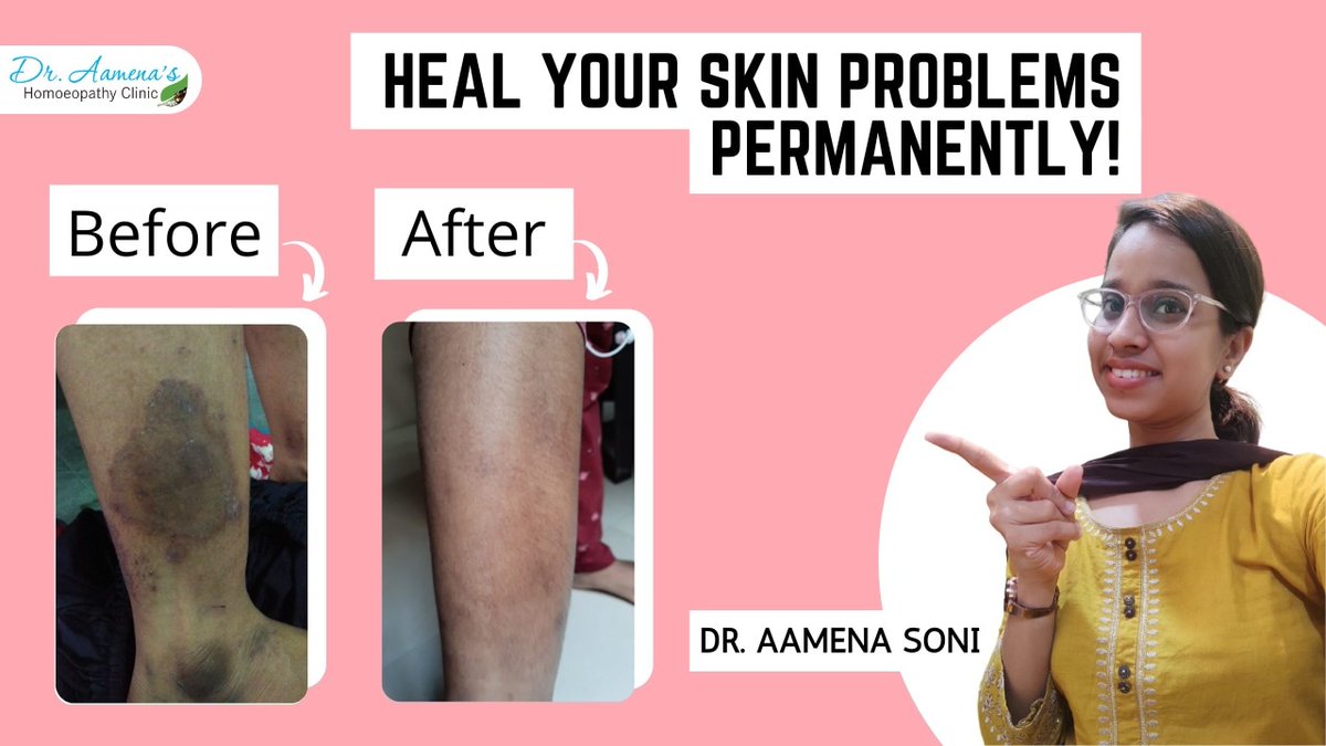 draamena's tweet photo. This video will help  you understand that using only skin products won't help you heal your skin issues but there is something more to it which you need to add for your skin care/issues. 

Video link:
https://t.co/W3G1UvtRNx https://t.co/jFyilJqCwv