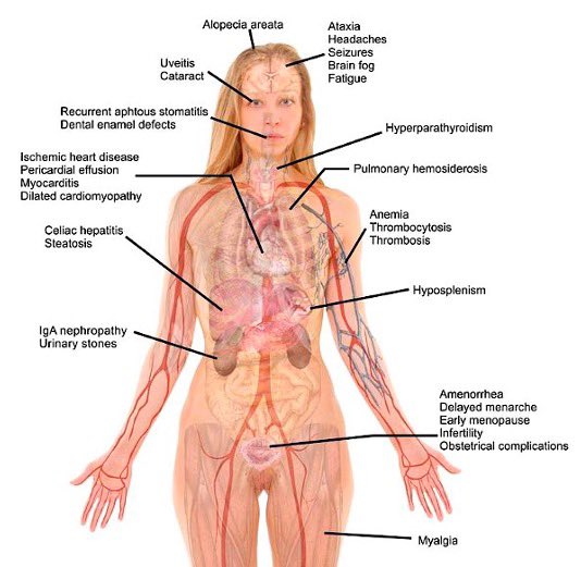 trott_nick's tweet photo. #ShineALightOnCoeliacDisease

A Gluten Free diet for #Coeliac Disease is not a 'Lifestyle Choice'.

And Coeliac Disease is not just 'Tummy Troubles'..

Its a Multi-System Auto-Immune disease with extra-intestinal manifestations &amp; associated conditions.

📚 https://t.co/KffjJirf6t https://t.co/XgEN2kIYYB