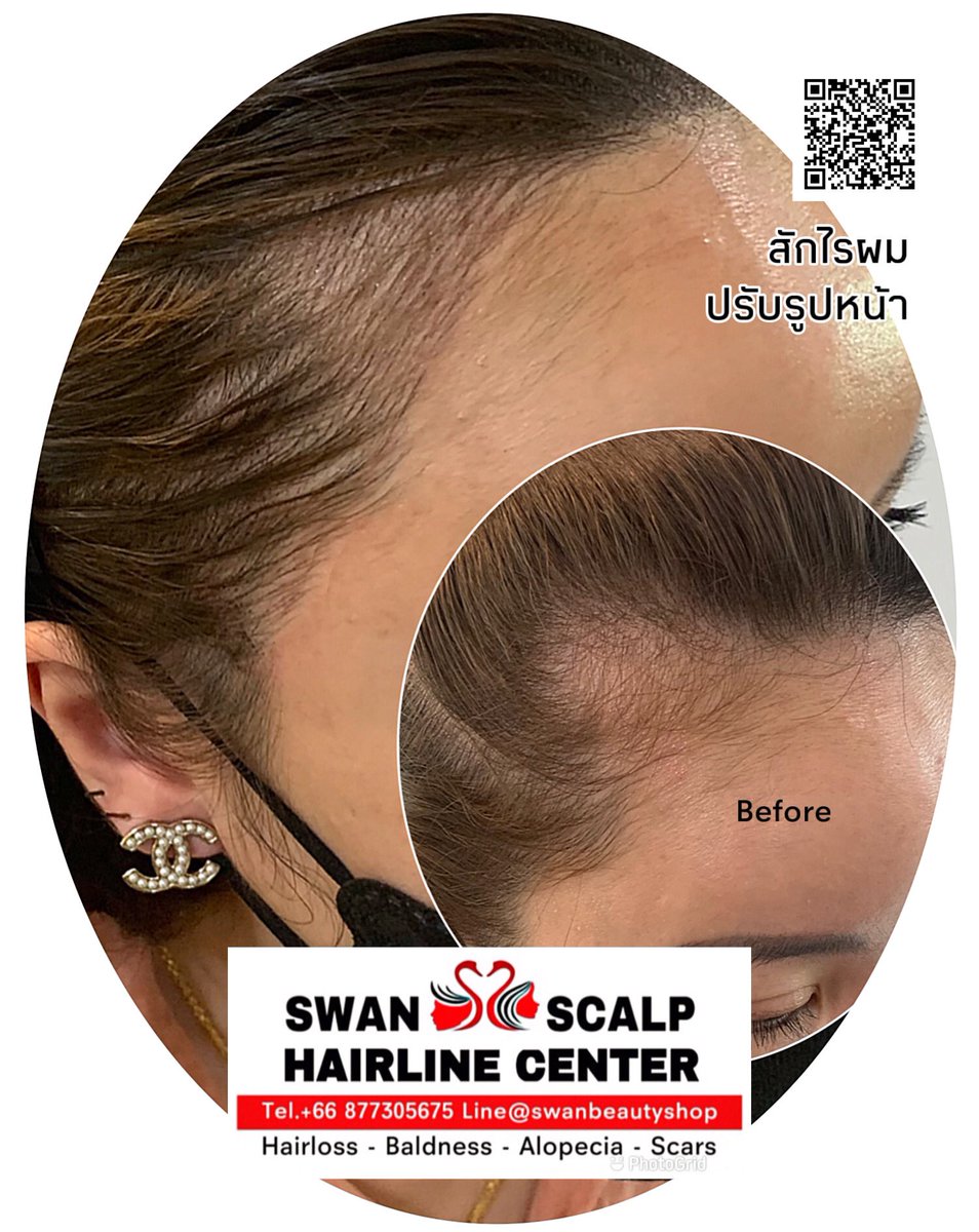 HairlineScalp's tweet photo. สักไรผมสวยเนียนเป็นผธรรมชาติสมจริง ที่SwanScalpHairlineCenter https://t.co/6a55rITQ9m