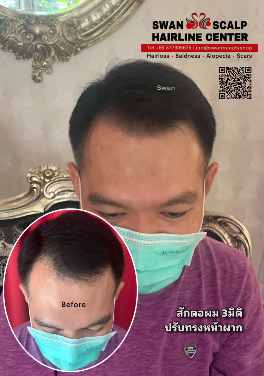 HairlineScalp's tweet photo. เคยปลูกผมมาแล้ว แต่ผิดหวัง แถมผมบางมากกว่าเดิม ถ้ารู้ว่ามีการสักตอผมแบบนี้ คงมาทำไปแต่แรก!! #สักผมกึ่งการแพทย์ #ผมบาง #หัวล้าน #สักปิดหัวเถิก #สักปิดรอยแผลหลังศัลยกรรมโดยครูเอ้Swan #สอนสักหัวล้าน #สักหัวล้าน #สักไรผมกรุงเทพ #สักไรผมผู้หญิง #สักรักษาโรคAlopicia #สักตอผมครูเอ้swan https://t.co/s51yjbwvgh