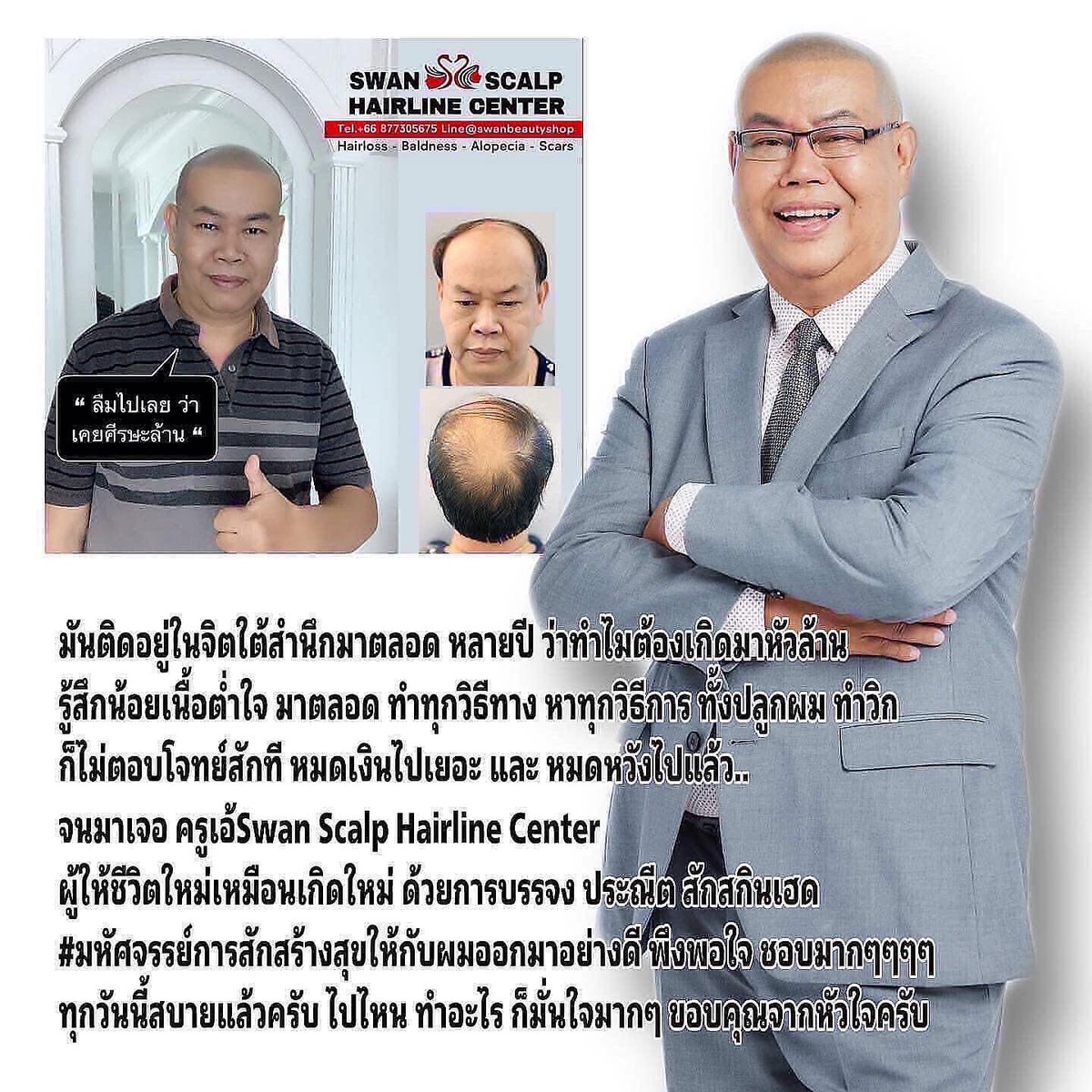 HairlineScalp's tweet photo. เคยปลูกผมมาแล้ว แต่ผิดหวัง แถมผมบางมากกว่าเดิม ถ้ารู้ว่ามีการสักตอผมแบบนี้ คงมาทำไปแต่แรก!! #สักผมกึ่งการแพทย์ #ผมบาง #หัวล้าน #สักปิดหัวเถิ�� #สักปิดรอยแผลหลังศัลยกรรมโดยครูเอ้Swan #สอนสักหัวล้าน #สักหัวล้าน #สักไรผมกรุงเทพ #สักไรผมผู้หญิง #สักรักษาโรคAlopicia #สักตอผมครูเอ้swan https://t.co/fYu9bumyeS