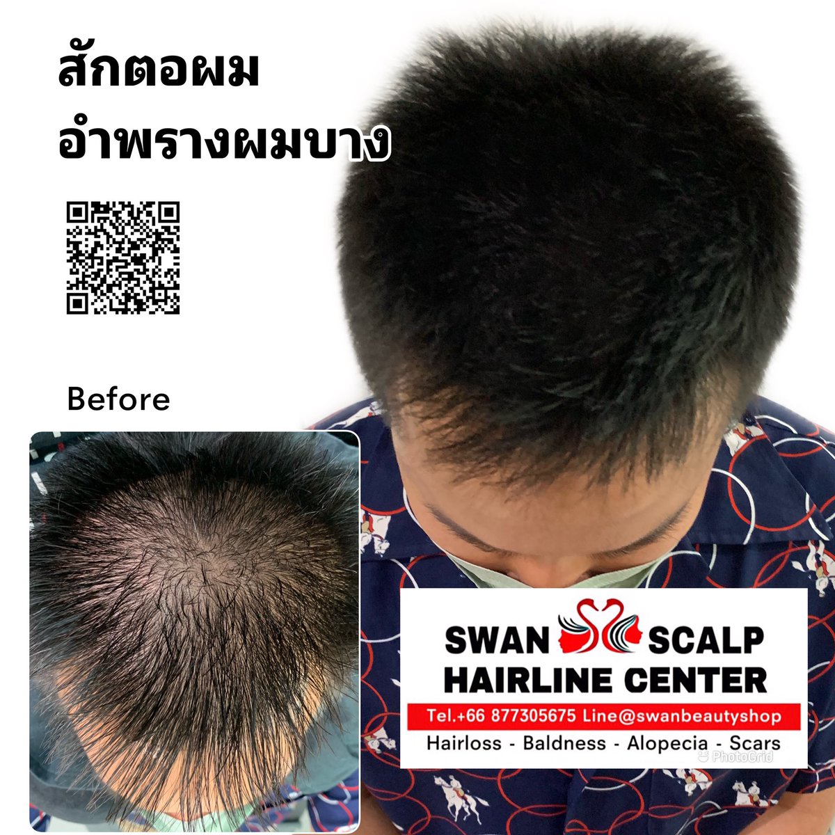 HairlineScalp's tweet photo. เคยปลูกผมมาแล้ว แต่ผิดหวัง แถมผมบางมากกว่าเดิม ถ้ารู้ว่ามีการสักตอผมแบบนี้ คงมาทำไปแต่แรก!! #สักผมกึ่งการแพทย์ #ผมบาง #หัวล้าน #สักปิดหัวเถิ�� #สักปิดรอยแผลหลังศัลยกรรมโดยครูเอ้Swan #สอนสักหัวล้าน #สักหัวล้าน #สักไรผมกรุงเทพ #สักไรผมผู้หญิง #สักรักษาโรคAlopicia #สักตอผมครูเอ้swan https://t.co/fYu9bumyeS