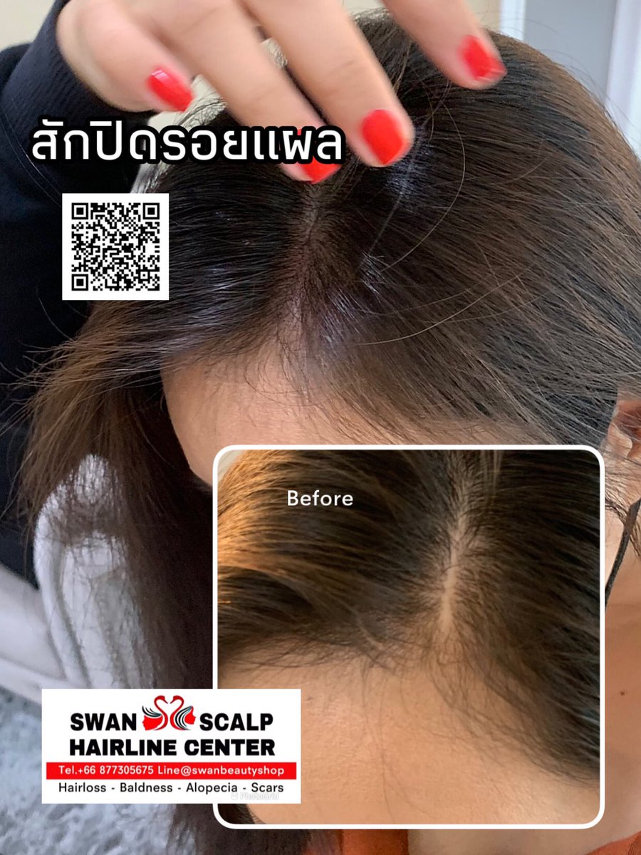 HairlineScalp's tweet photo. เคยปลูกผมมาแล้ว แต่ผิดหวัง แถมผมบางมากกว่าเดิม ถ้ารู้ว่ามีการสักตอผมแบบนี้ คงมาทำไปแต่แรก!! #สักผมกึ่งการแพทย์ #ผมบาง #หัวล้าน #สักปิดหัวเถิ�� #สักปิดรอยแผลหลังศัลยกรรมโดยครูเอ้Swan #สอนสักหัวล้าน #สักหัวล้าน #สักไรผมกรุงเทพ #สักไรผมผู้หญิง #สักรักษาโรคAlopicia #สักตอผมครูเอ้swan https://t.co/fYu9bumyeS