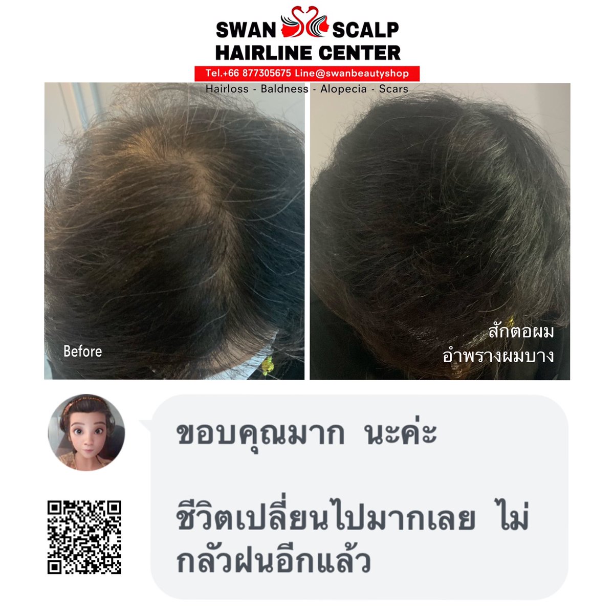HairlineScalp's tweet photo. เคยปลูกผมมาแล้ว แต่ผิดหวัง แถมผมบางมากกว่าเดิม ถ้ารู้ว่ามีการสักตอผมแบบนี้ คงมาทำไปแต่แรก!! #สักผมกึ่งการแพทย์ #ผมบาง #หัวล้าน #สักปิดหัวเถิ�� #สักปิดรอยแผลหลังศัลยกรรมโดยครูเอ้Swan #สอนสักหัวล้าน #สักหัวล้าน #สักไรผมกรุงเทพ #สักไรผมผู้หญิง #สักรักษาโรคAlopicia #สักตอผมครูเอ้swan https://t.co/fYu9bumyeS