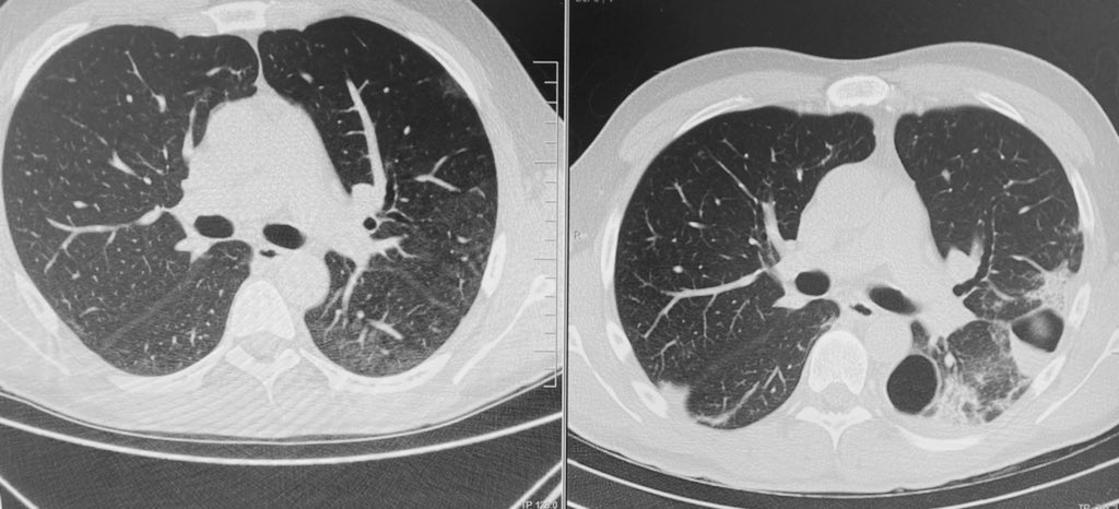 cmanzanonml's tweet photo. 1 month postCOVID19 infection - Bilateral cavitated images and their resolution after 2 months. Low PCR levels, no infectious symptoms. Negative repetitive sputum cultures.

Dx: Bullous disease postCOVID
#PostCovid #Pneumo #RespiratoryMedicine https://t.co/BpvCreDFmJ