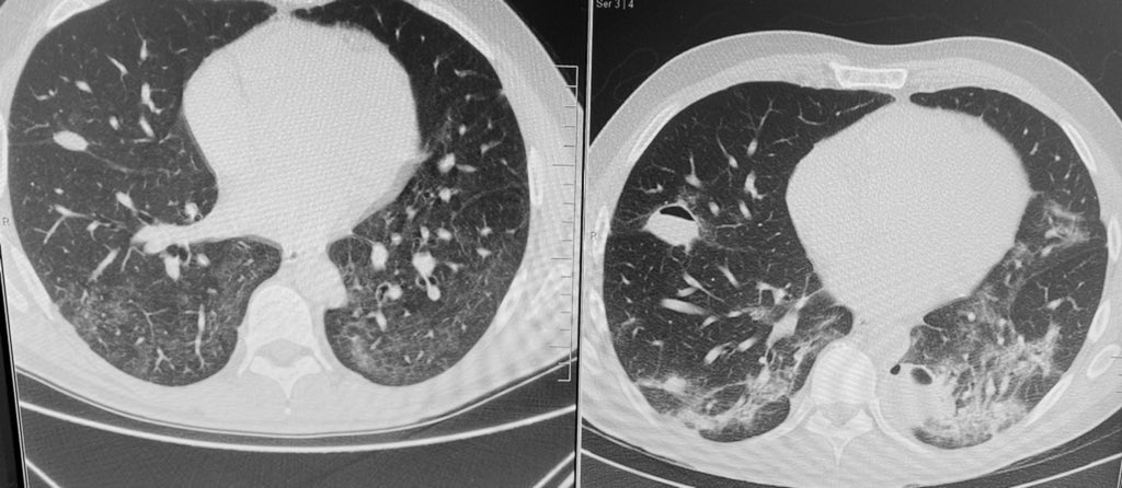 cmanzanonml's tweet photo. 1 month postCOVID19 infection - Bilateral cavitated images and their resolution after 2 months. Low PCR levels, no infectious symptoms. Negative repetitive sputum cultures.

Dx: Bullous disease postCOVID
#PostCovid #Pneumo #RespiratoryMedicine https://t.co/BpvCreDFmJ