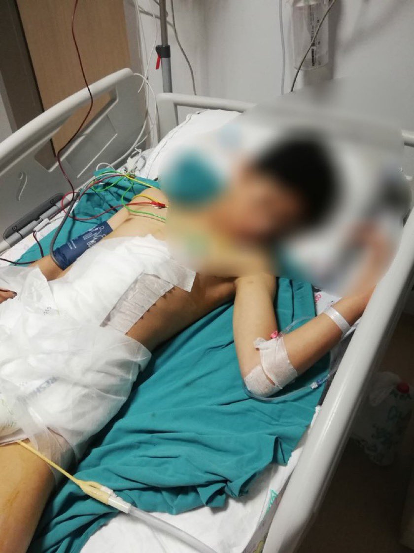 serdarkilic9's tweet photo. Bu yavru Çorum'da yoğun bakımda yaşam mücadelesi veriyor.Sokakların insanlara ait olduğunu ve orada çocukluğunu yaşayabileceğini düşünmüş.İyi bakın sokakların köpeklerin doğal yaşam ve saldırı alanı olduğunu ilan eden belediyeler.Tüm sorumlular gibi bunda sizin de #vebalinizvar https://t.co/dY8aEkw8WV