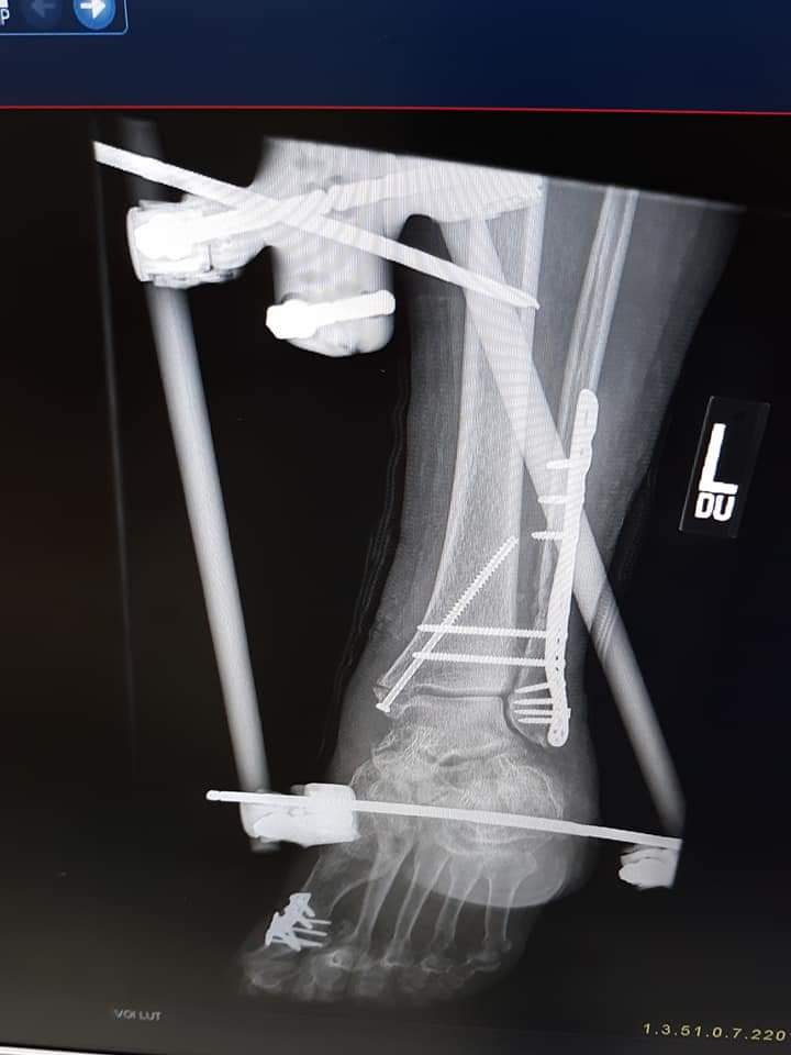 HyltonAndi's tweet photo. A year of hell  from a fall from a latter and end up losing my foot and part of my leg .... https://t.co/SPCzKus0Yj