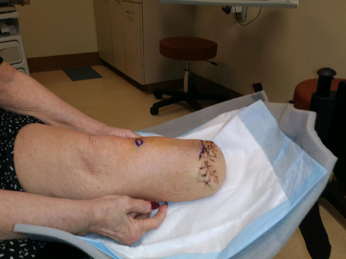 HyltonAndi's tweet photo. A year of hell  from a fall from a latter and end up losing my foot and part of my leg .... https://t.co/SPCzKus0Yj