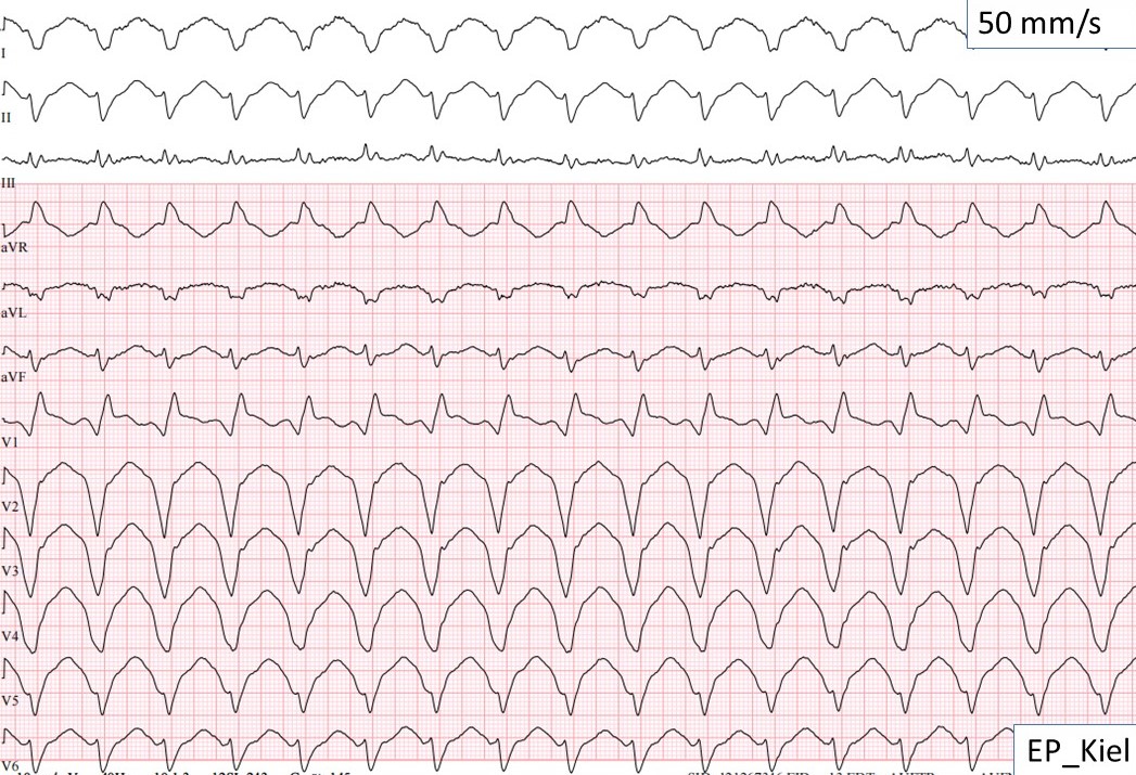 78yo man with ischemic heart disease and sustained VTs. 
#EPeeps guess the origin of VT!
Mapping and ablation, as always, come soon😉
<a href="/evgeny_lyan/">Evgeny Lian</a> <a href="/ThomasDemming/">Thomas Demming</a> #CardioTwitter #EP_Kiel #FOAMed <a href="/EPeeps_Bot/">EP_Bot</a> <a href="/UKSH_KI_HL/">Universitätsklinikum Schleswig-Holstein</a> <a href="/EcgKiel/">ECG_Kiel</a>