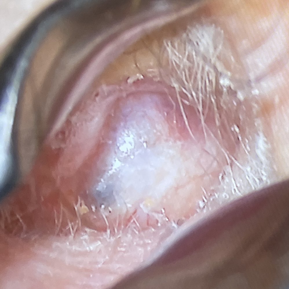 WilliamRBlythe's tweet photo. One of the first modified radical mastoidectomies I performed in practice. 1998. This was the patient’s 6th and final surgery. The hearing is dismal, but the ear is healthy and clean and he is delighted.
#ENTwitter #GeneralENT https://t.co/5Cc0QZaq4t