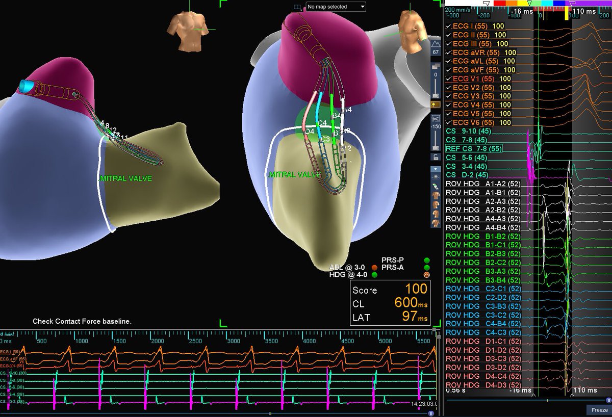 TY_TACKacardia's tweet photo. WPW pt presented in incessant AVRT w/ BL LBB. #Floroless TxP performed with #viewflexICE by @drbilalmunir and @FarshadRaissi. #Openwindowmapping of AP was performed and gorgeous AP potentials were recorded by #HDGrid. < 2s of RF w/ #TCSE to demonstrate loss of delta wave on EKG https://t.co/LHOGCESqTi