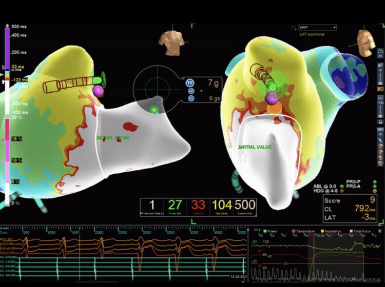 TY_TACKacardia's tweet photo. WPW pt presented in incessant AVRT w/ BL LBB. #Floroless TxP performed with #viewflexICE by @drbilalmunir and @FarshadRaissi. #Openwindowmapping of AP was performed and gorgeous AP potentials were recorded by #HDGrid. < 2s of RF w/ #TCSE to demonstrate loss of delta wave on EKG https://t.co/LHOGCESqTi
