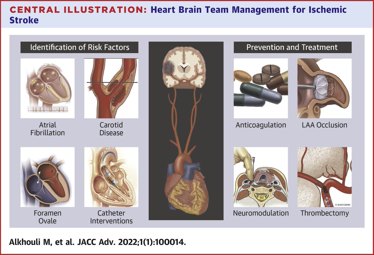 JACCJournals's tweet photo. Comprehensive prevention &amp; management of ischemic #stroke requires a heart-brain team-based approach. Read this state-of-the-art review by Dr. @adnanalkhouli et al. published in #JACCAdvances to learn about challenges &amp; opportunities: https://t.co/MkRU1bkH3d #CardioTwitter https://t.co/JT593yUH1J
