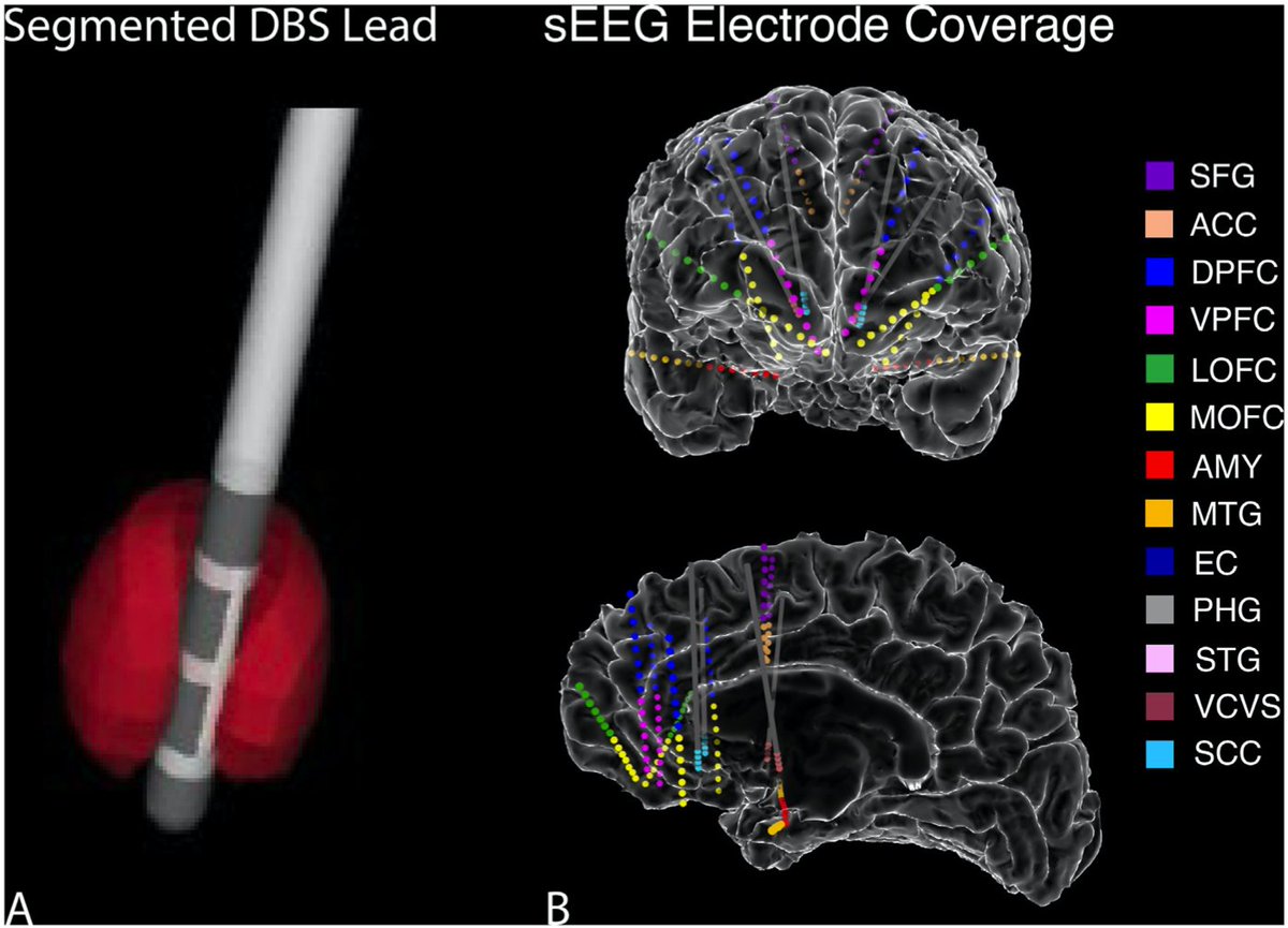 SameerShethMD's tweet photo. 1/7 Check out our recent paper in @brainstimj drilling down on prefrontal connectivity using a unique opp from our #BRAINInitative funded #DBS for #Depression trial. We have DBS leads in VC/VS and SCC, and sEEG throughout PFC. https://t.co/SWYHONAmKY https://t.co/k1URiKnbUi